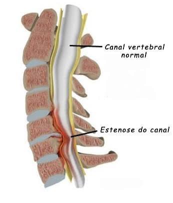 Estenose Vertebral